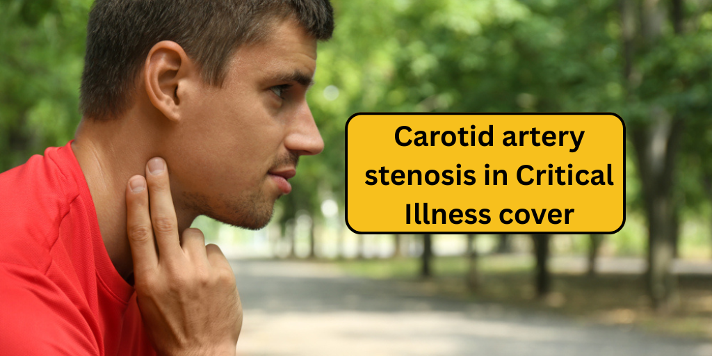 Carotid artery stenosis in Critical Illness cover