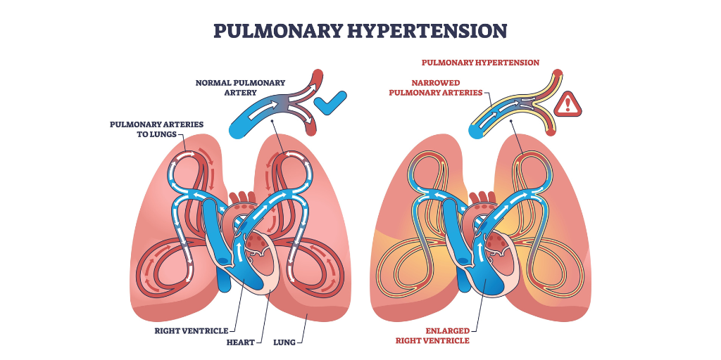 Pulmonary hypertension in Critical Illness cover