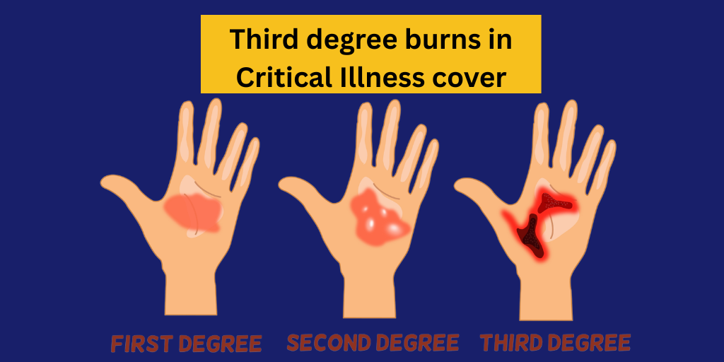 Third degree burns in Critical Illness cover